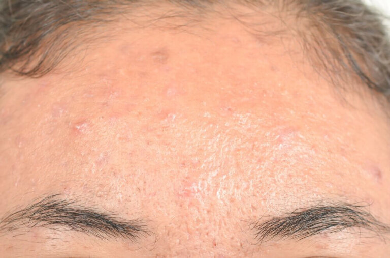 Dermatite seborroica: 5 efficaci rimedi naturali