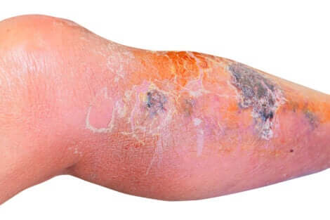 Erisipela: gamba colpita da infezione batterica.
