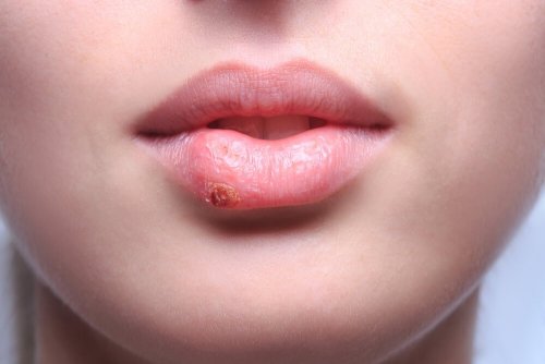 Herpes labiale