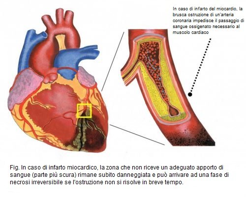 Infarto del miocardio
