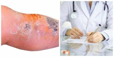 Trattamento dell'erisipela