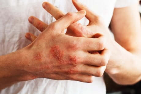Sintomi della psoriasi.
