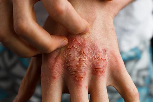Salsapariglia per il trattamento della psoriasi Salsapariglia per il trattamento della psoriasi