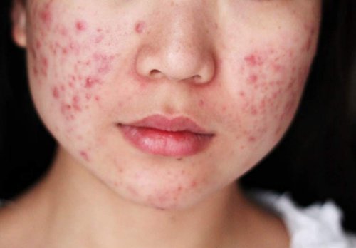 Volto pieno di acne