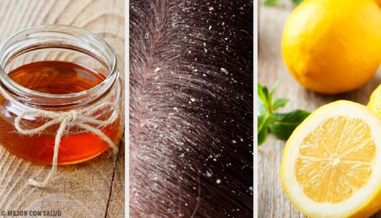 10 rimedi naturali efficaci contro la forfora