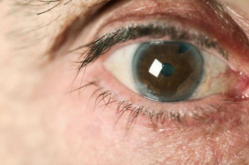 migliorare il glaucoma