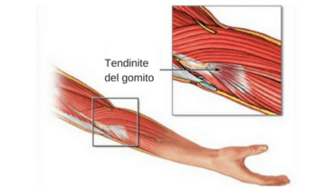 Rimedi naturali per alleviare una tendinite