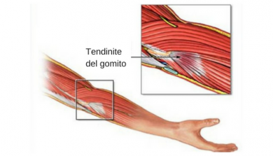 Rimedi naturali per alleviare una tendinite