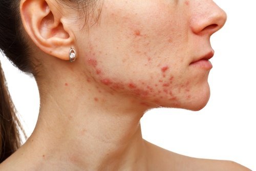 Acne in viso
