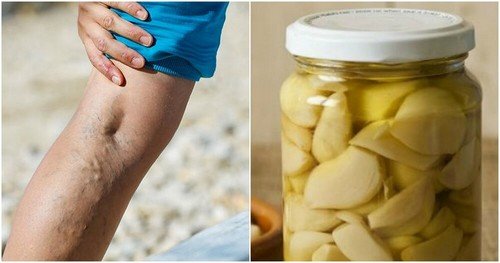Pomata all'aglio e limone per le varici