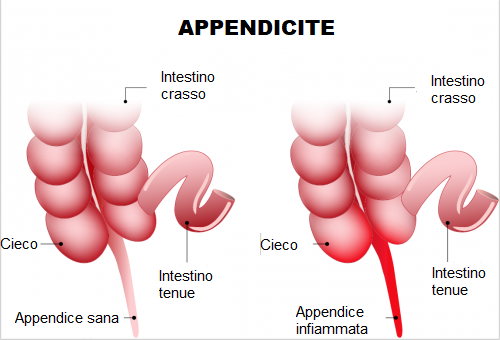 Come riconoscere l'appendicite