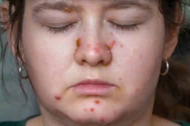 Eliminare i brufoli sul naso con 5 rimedi naturali