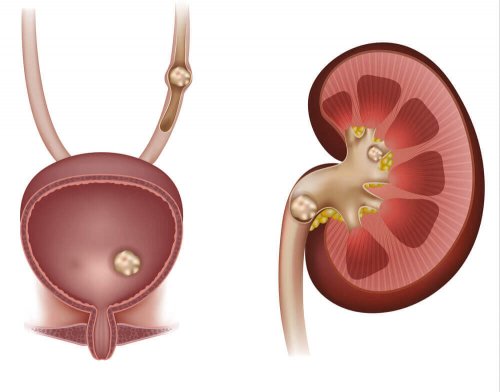 spaccapietre gocce serve anche per la prostata spaccapietre gocce serve anche per la prostata
