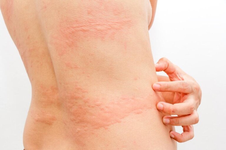 Come calmare l’orticaria con 3 rimedi naturali