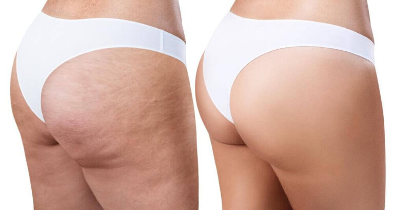 Eliminare la cellulite con rimedi efficaci