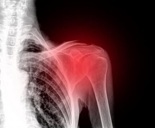 Diminuite il dolore alla spalla con questi rimedi fatti in casa