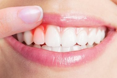 Infezione gengivale: 4 metodi per alleviarla