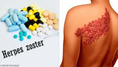 Herpes sulla schiena: i 5 migliori rimedi
