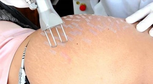 Trattamenti per le smagliature