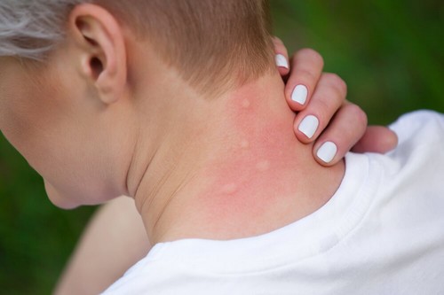 Reazioni allergiche da punture di insetto: 5 rimedi