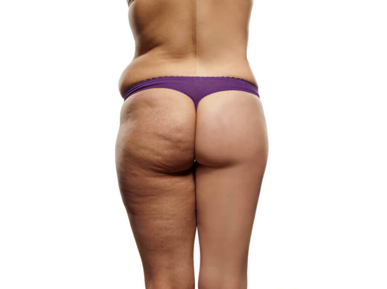 Ridurre la cellulite: ecco la dieta da seguire