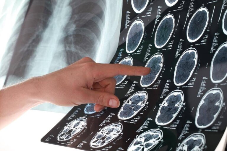 Prevenire un ictus: 6 sane abitudini