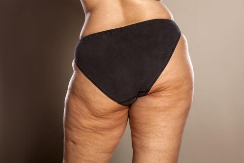 Fasi dello sviluppo della cellulite