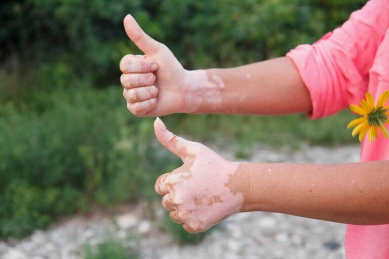 Malattie autoimmuni e alimenti: concessi e proibiti