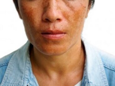 Attenuare un melasma: 3 trattamenti per ridurre le macchie