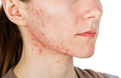Combattere l’acne dall’interno: 6 tisane naturali Combattere l’acne dall’interno: 6 tisane naturali