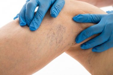 8 regole per curare le vene varicose