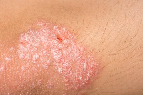 Eczema: i migliori rimedi naturali per alleviare i sintomi