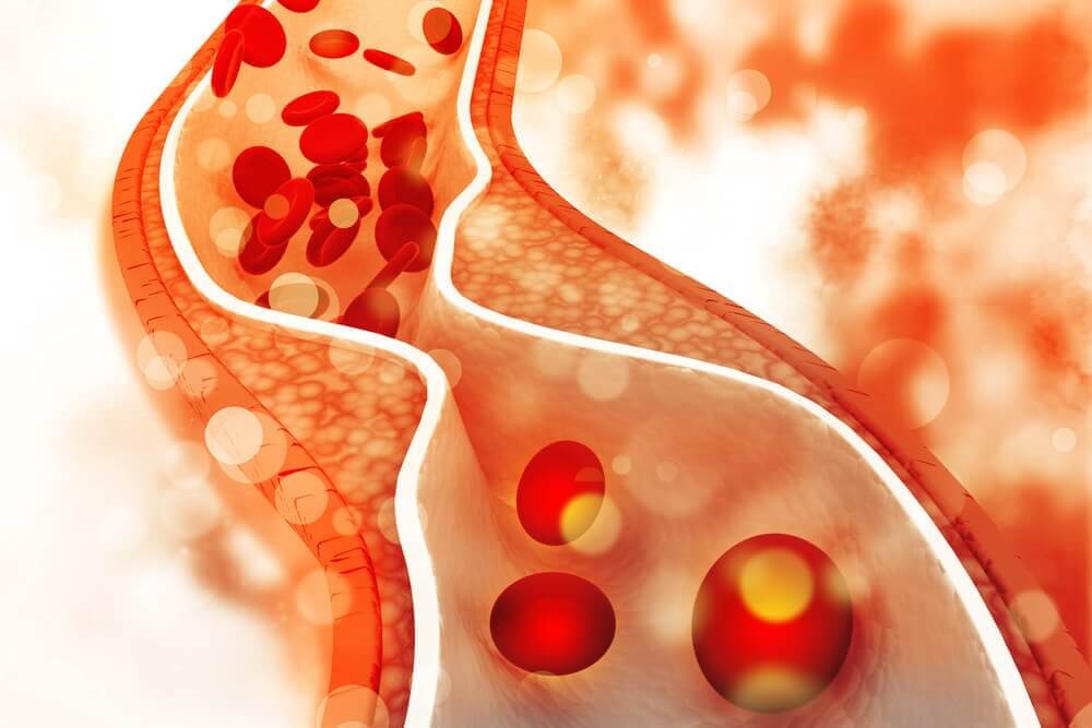 Immagine raffigurante effetti del colesterolo nel sangue
