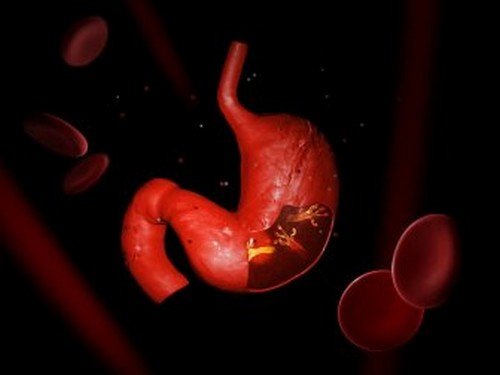 dopo il trattamento perdita di peso helicobacter pylori