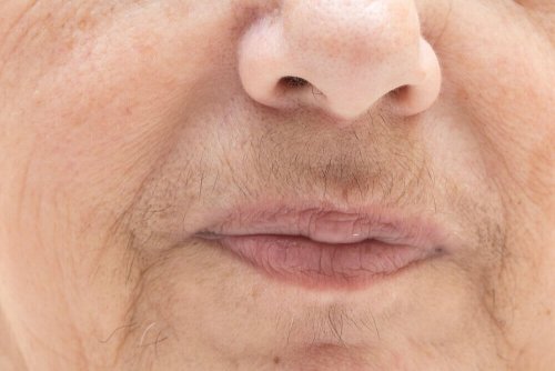 Irsutismo nella zona intorno alla bo