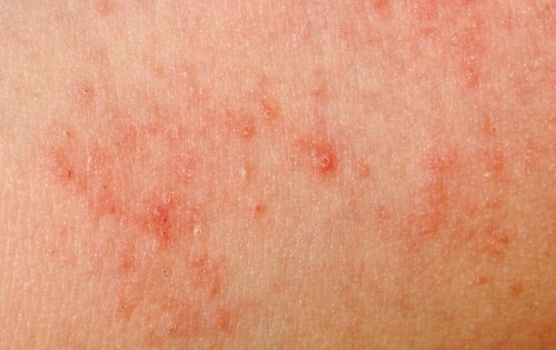 Eczema della pelle
