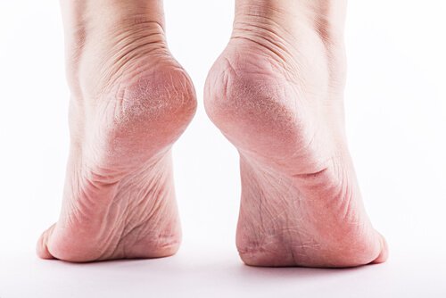 Piedi su mezzapunta con calli