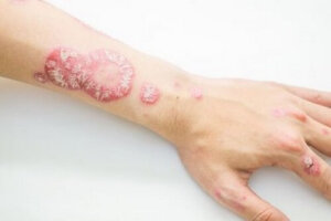 Rimedi naturali per la psoriasi: abitudini e trattamenti