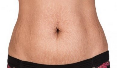 Trattamenti naturali per combattere le smagliature della pelle