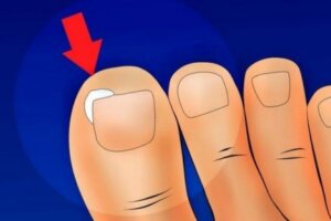 Come curare e prevenire le unghie incarnite