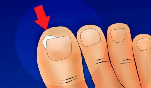 Come curare e prevenire le unghie incarnite