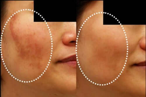 Melasma