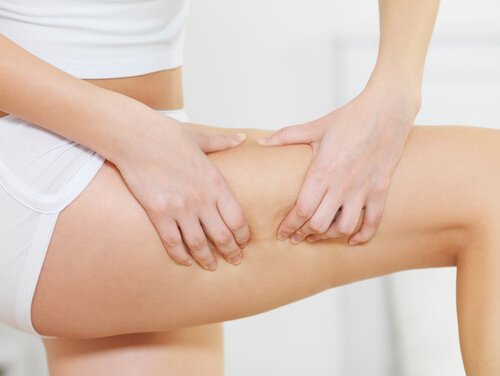 Cellulite sulle cosce