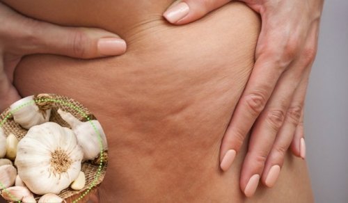 Cellulite sulle cosce