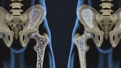 Prevenire l'osteoporosi con l'alimentazione: utili consigli
