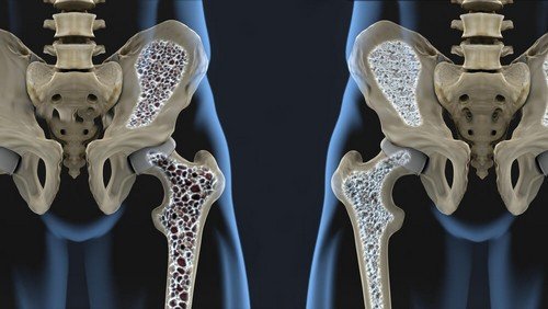 Prevenire l'osteoporosi