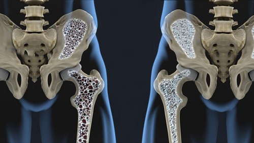Prevenire l'osteoporosi con l'alimentazione: utili consigli