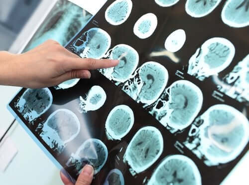 Principio di Alzheimer: è possibile fermare il processo?