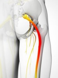 Calmare la sciatica: 5 impacchi naturali
