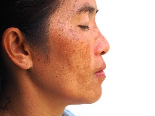 Attenuare il melasma con yogurt, banana e limone